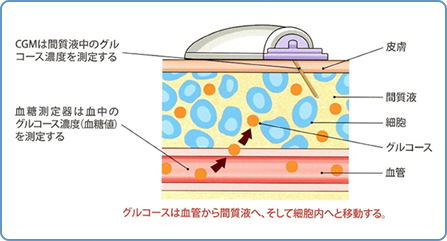 明石市 よこた内科クリニック 内科 糖尿病内科 腎臓内科 糖尿病について 持続血糖モニタリング Cgm
